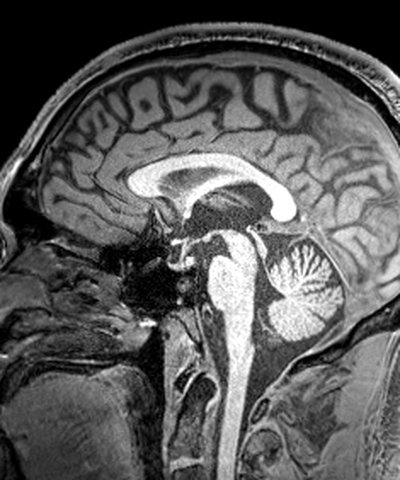 Mid-sagittal T1 MRI slice, May 2024